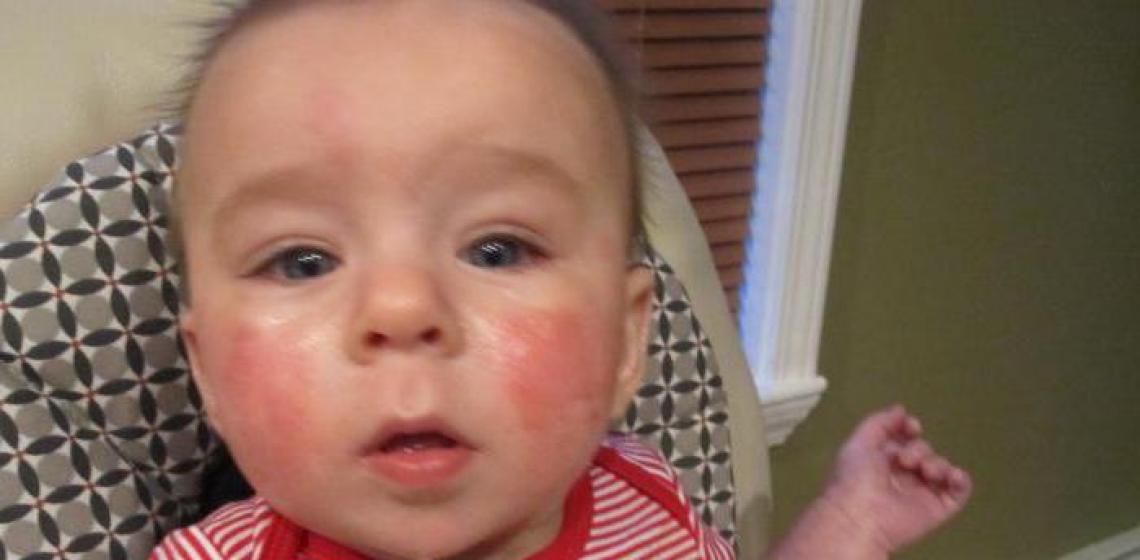 Красное пятно на щеке у ребенка: причины, проявления и особенности лечения