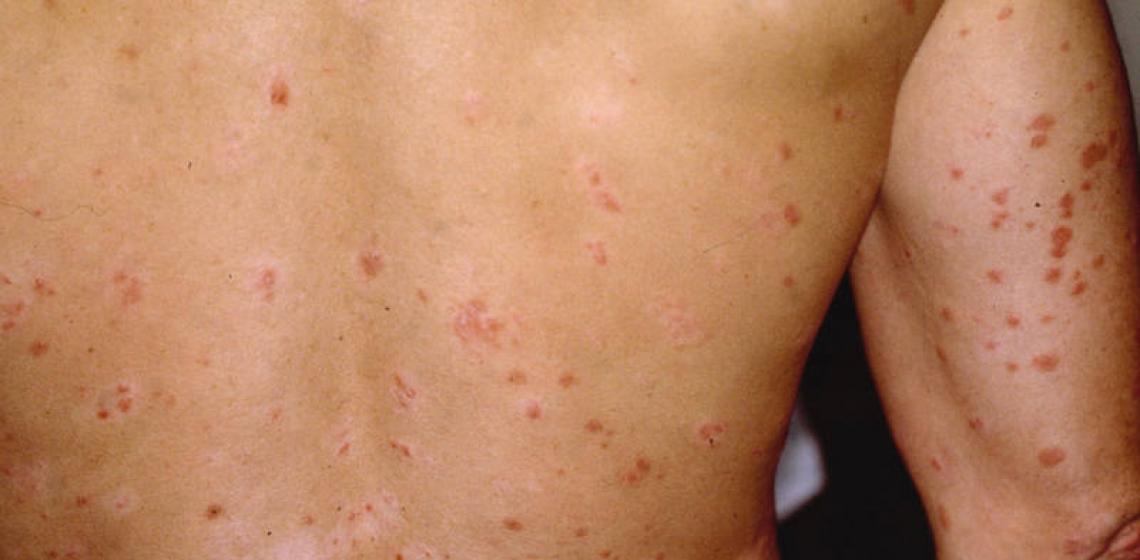 Kaj je lahko znak luščenja kože – možni vzroki in posledice, načini kako se ga znebiti?