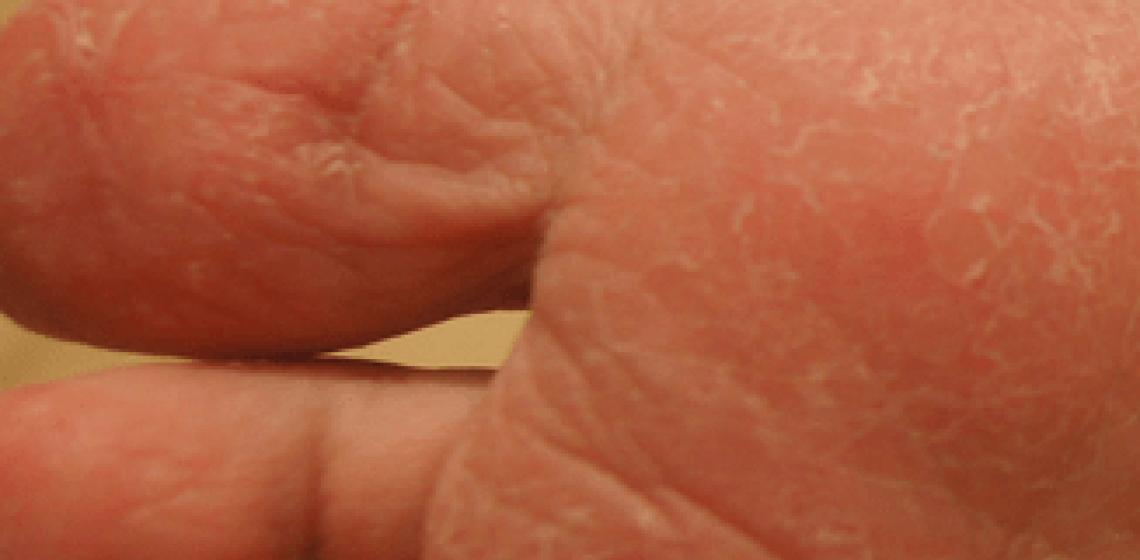 Vzroki in zdravljenje pilinga kože med prsti